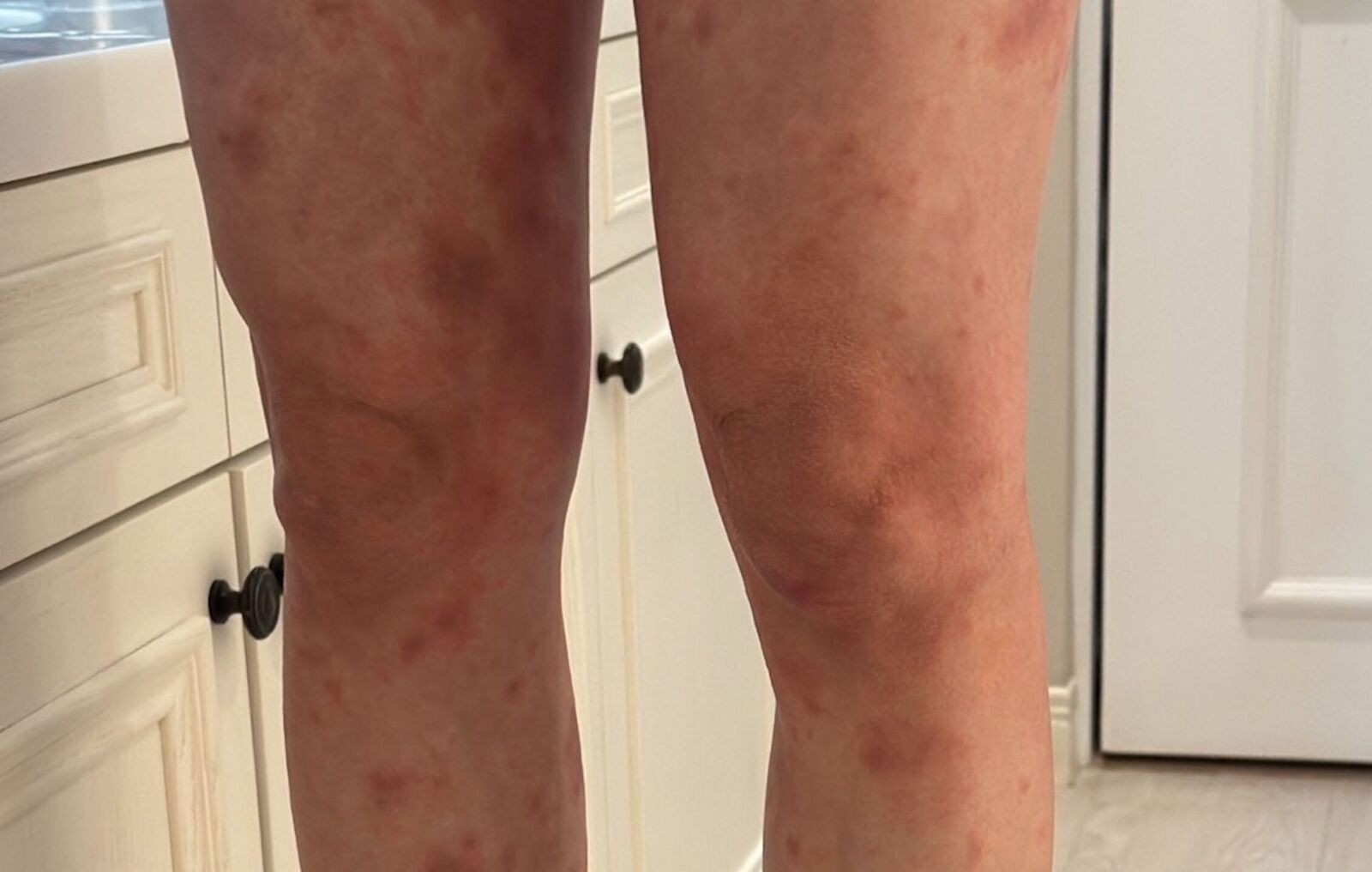 坐月子竟「癢」到全身腫！ 妊娠性蕁麻疹小心越補越糟