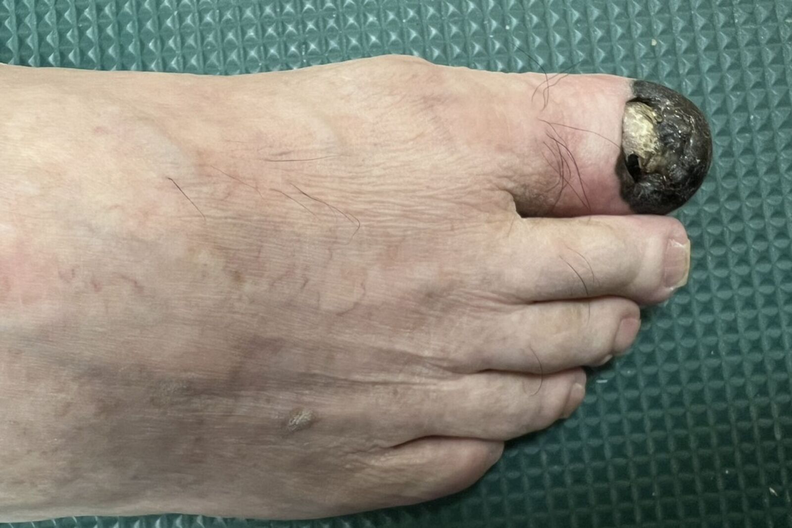 腳拇趾「黑一塊」踢到瘀青？ 越變越大竟是癌！他截肢保命